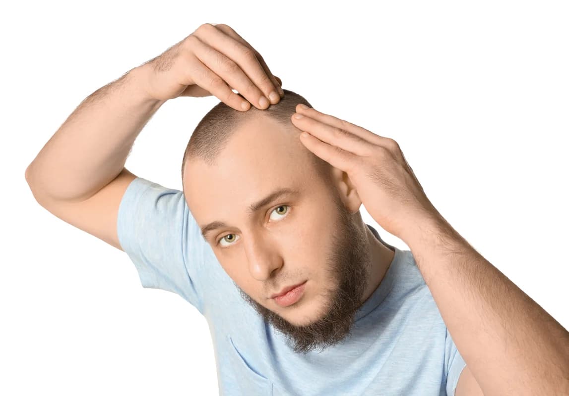 Genetik Saç Dökülmesi (Androgenetik Alopesi)