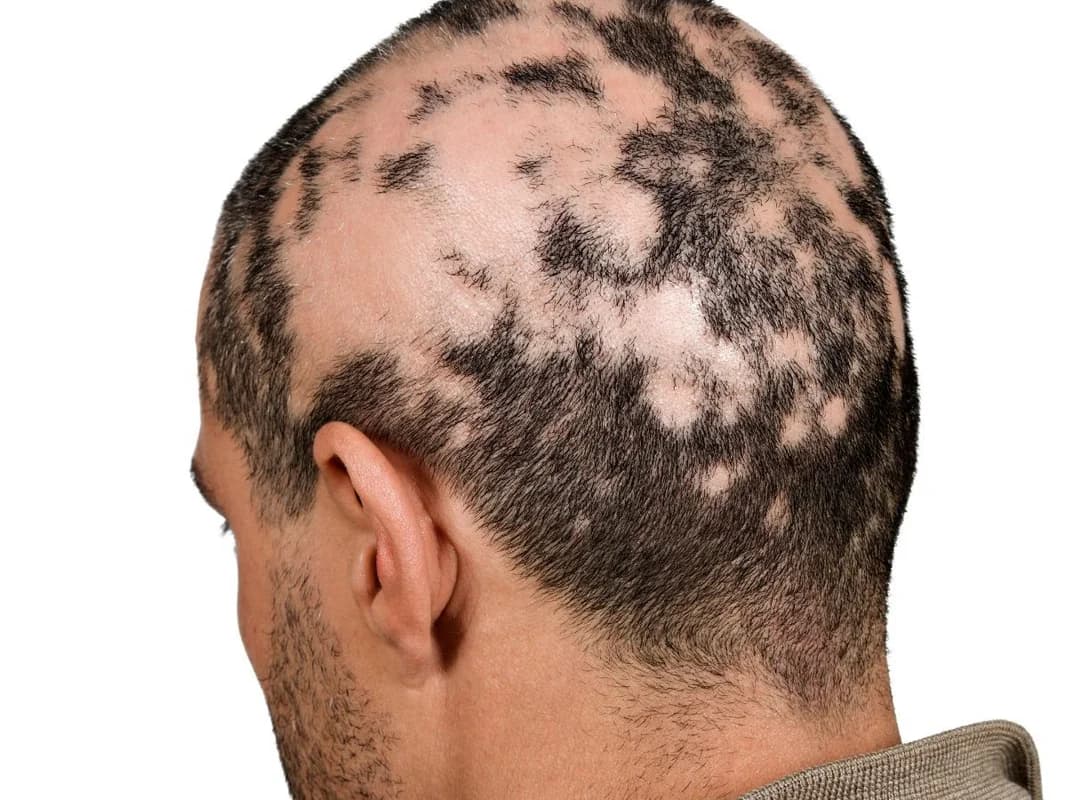 Saçkıran (Alopecia Areata)