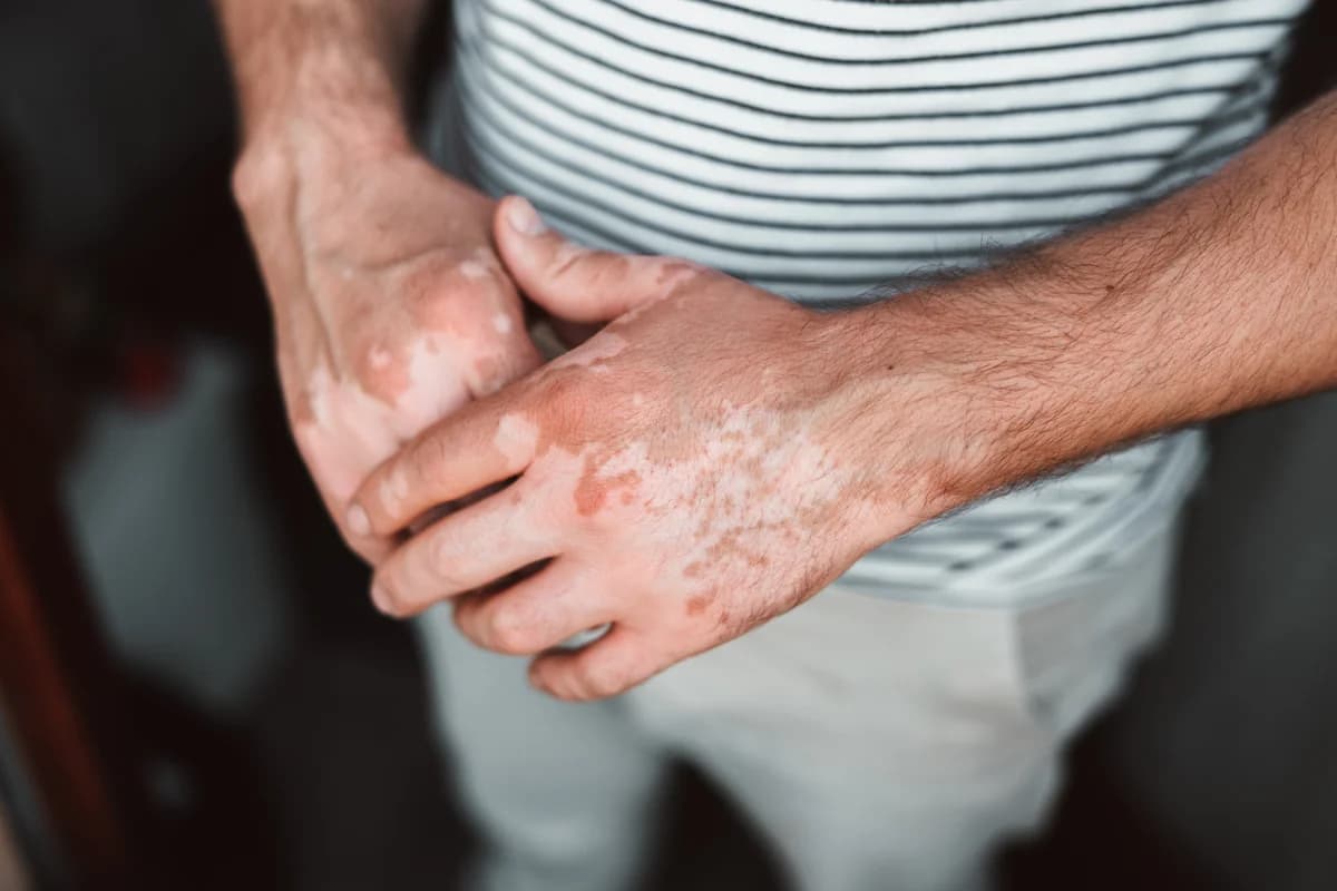 Sedef Hastalığı (Psoriasis)